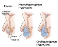 Водянка яичка (гидроцеле) у детей